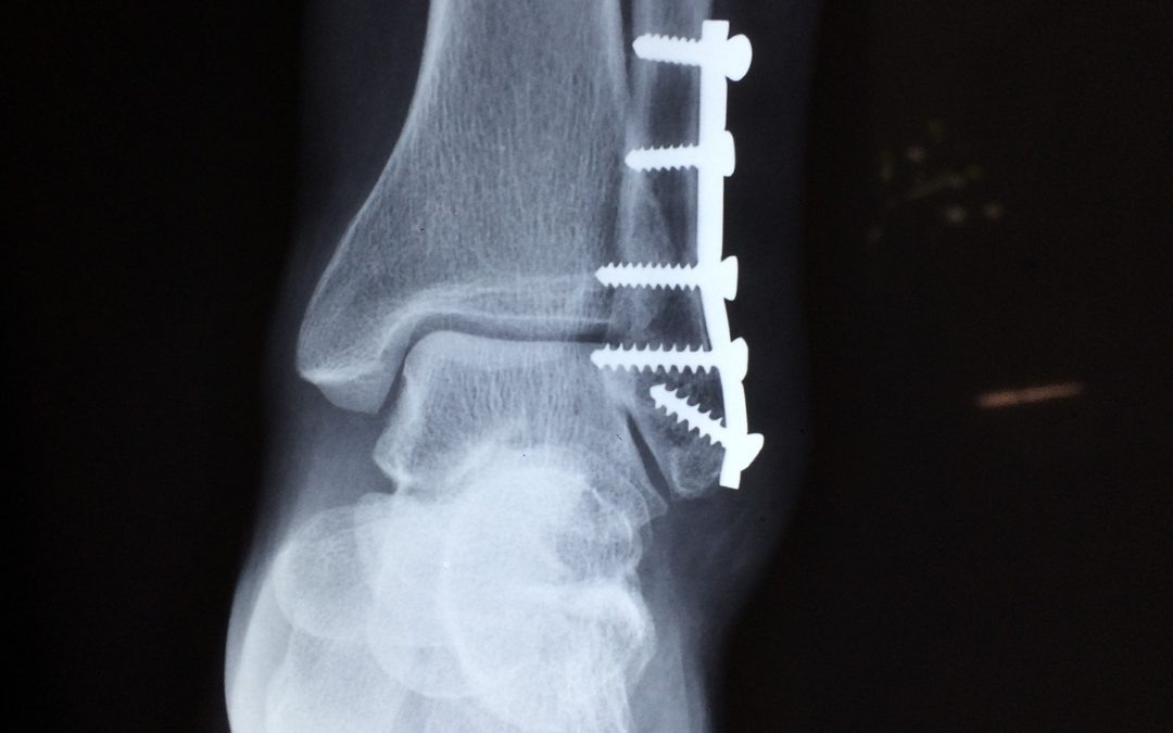 Krótka historia kopanej kostki…